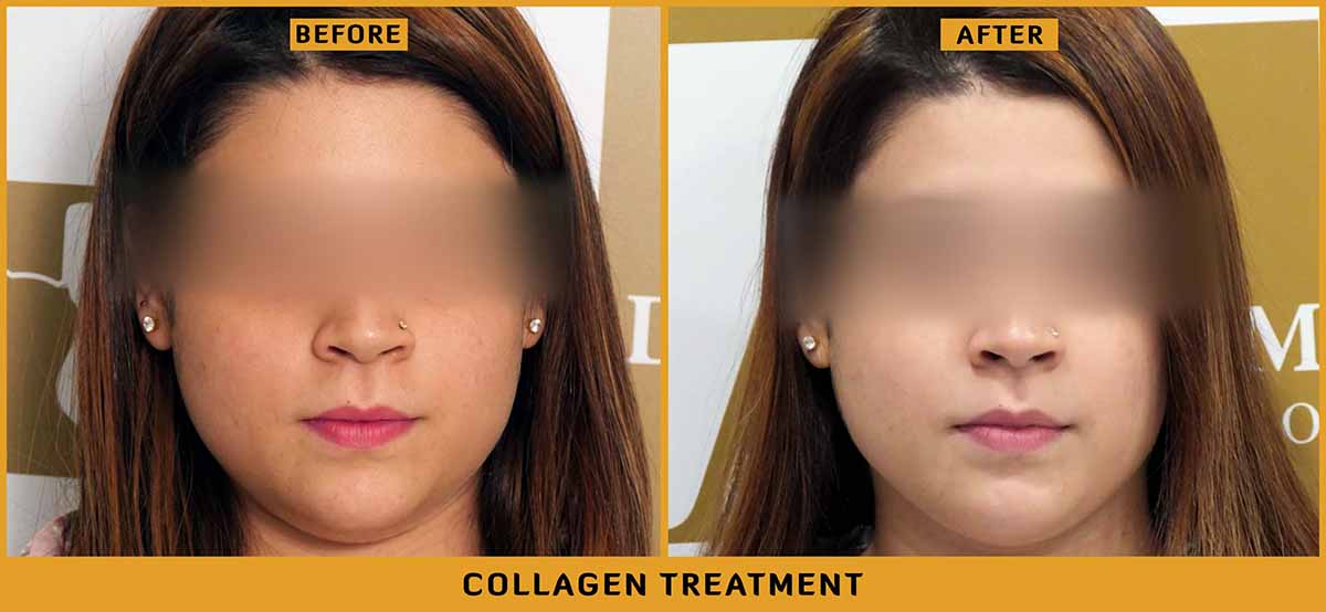 Delhi Collagen Treatment before and after